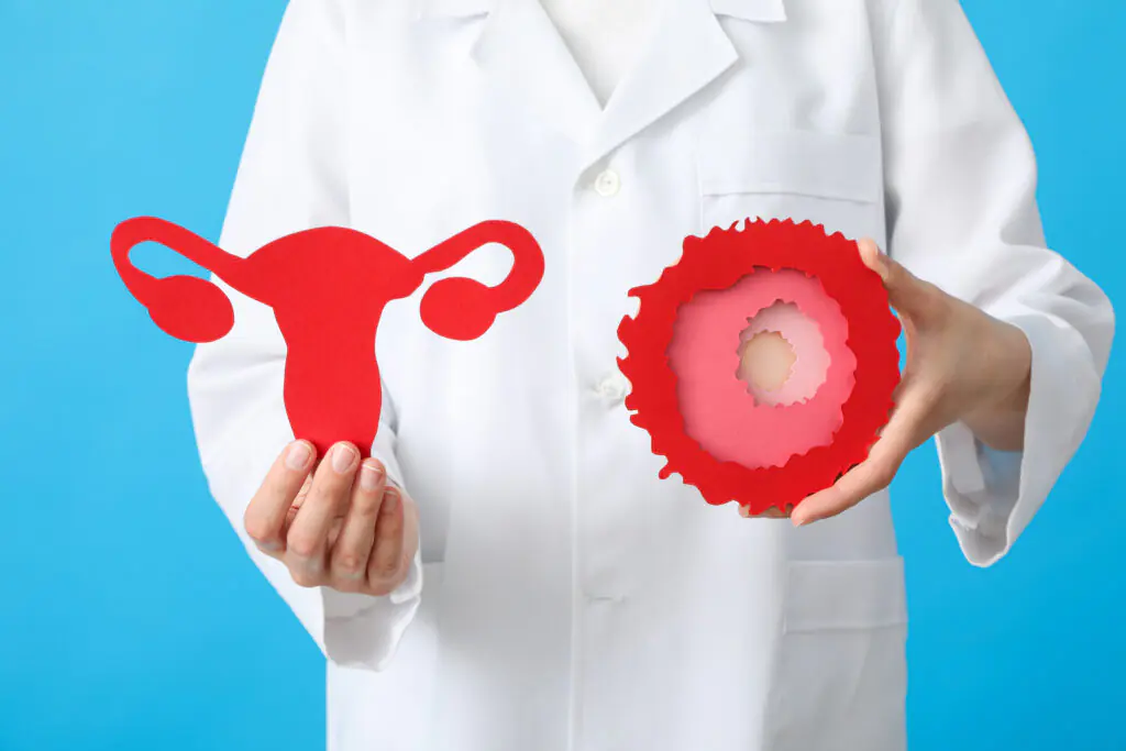 Difference Between Cyst and Fibroid