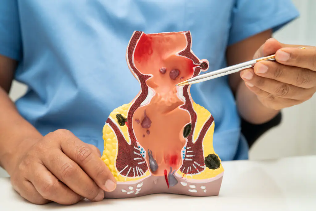 Difference Between Endometriosis and Ovarian Cyst