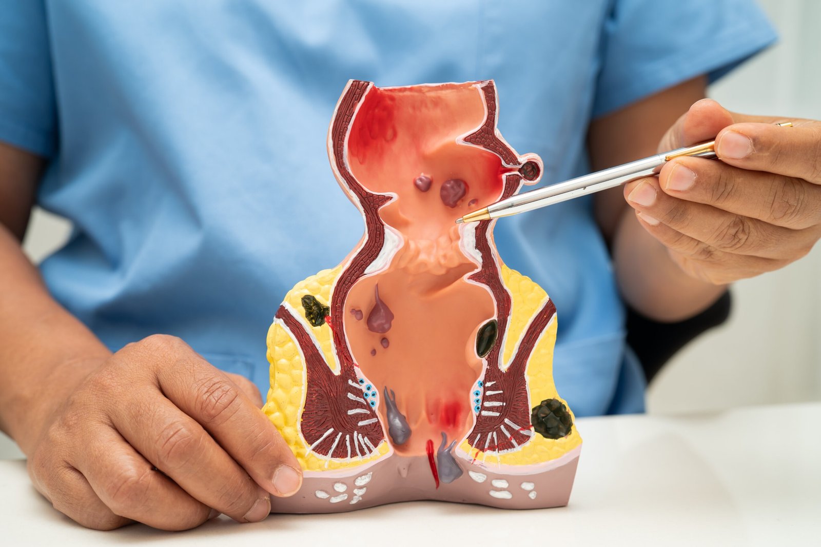 Difference Between Endometriosis and Ovarian Cyst